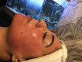 Microneedling Renewal Facial